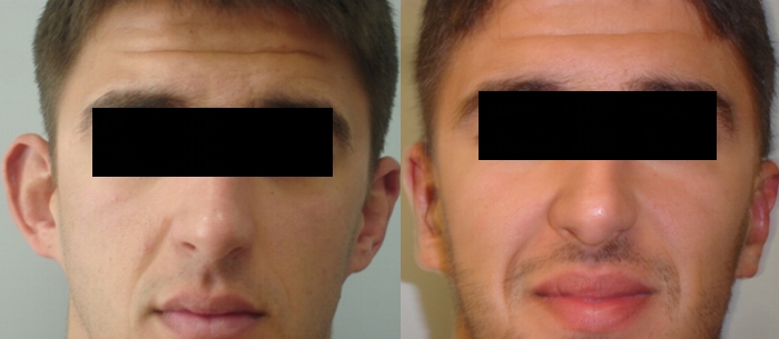 Otoplastika,  nakon  7 dana